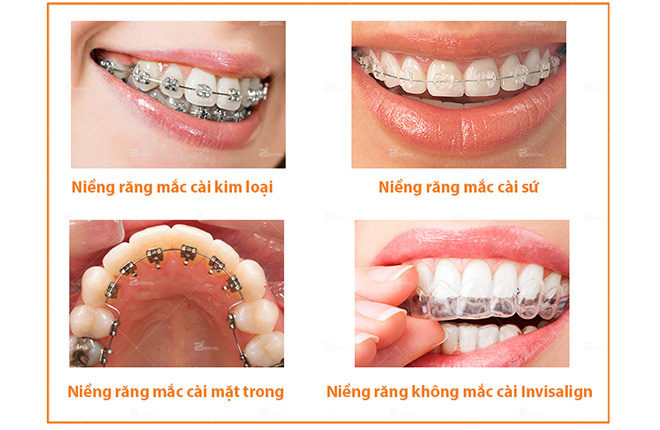 cac-loai-nieng-rang
