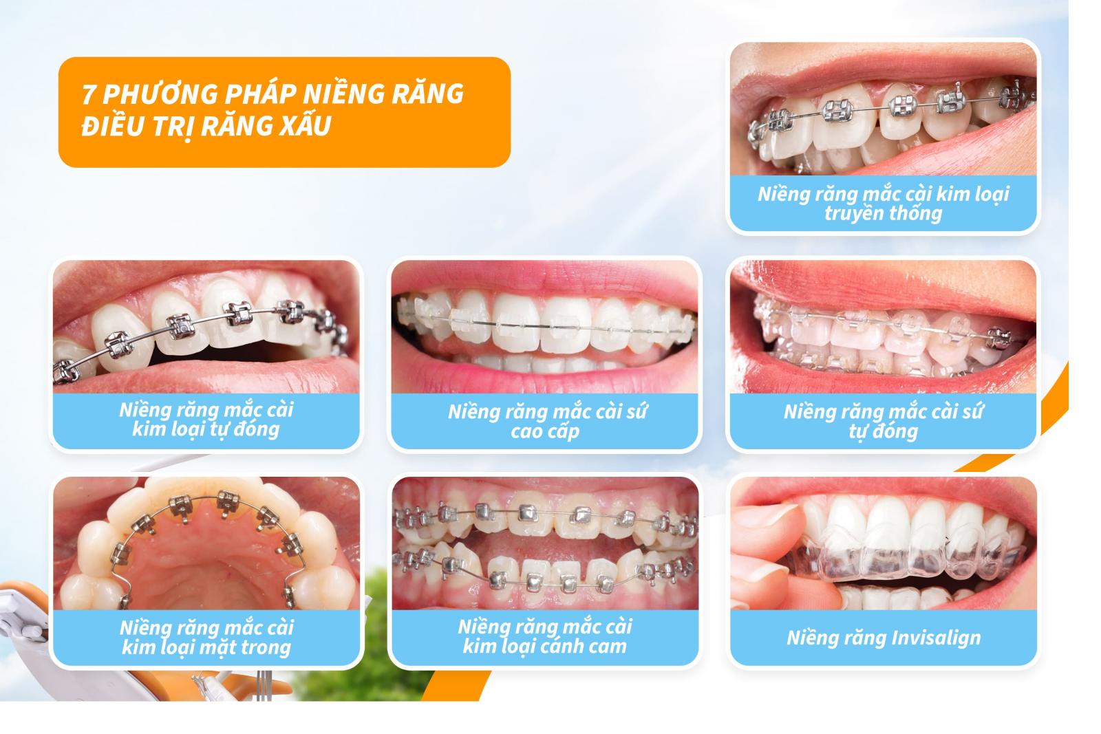 Các phương pháp niềng răng xấu hiệu quả