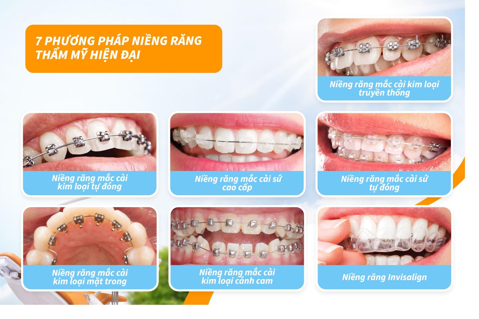 7 phương pháp niềng răng thẩm mỹ hiện đại