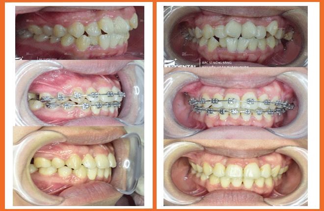 trước và sau khi niềng răng