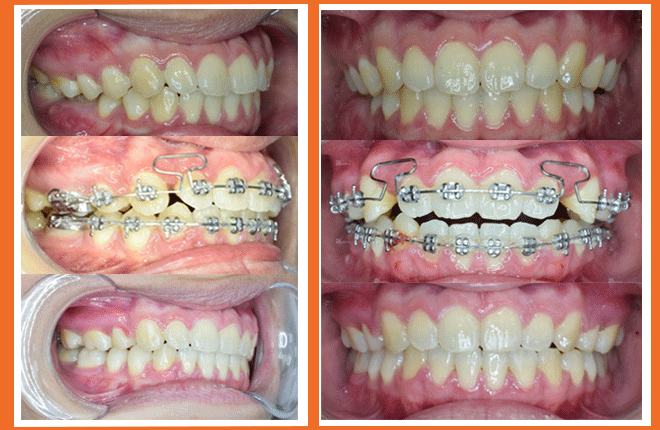 Trước - sau niềng răng