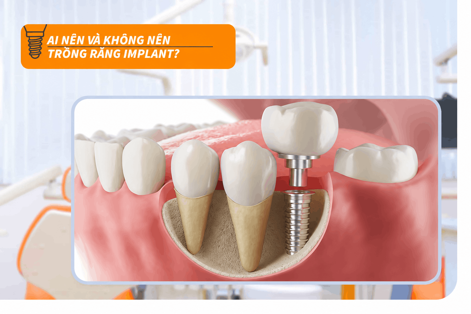 Ai nên và không nên trồng răng Implant?