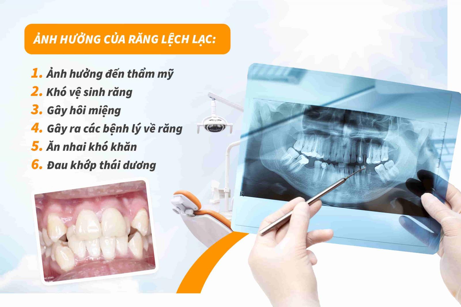 Ảnh hưởng của răng lệch lạc