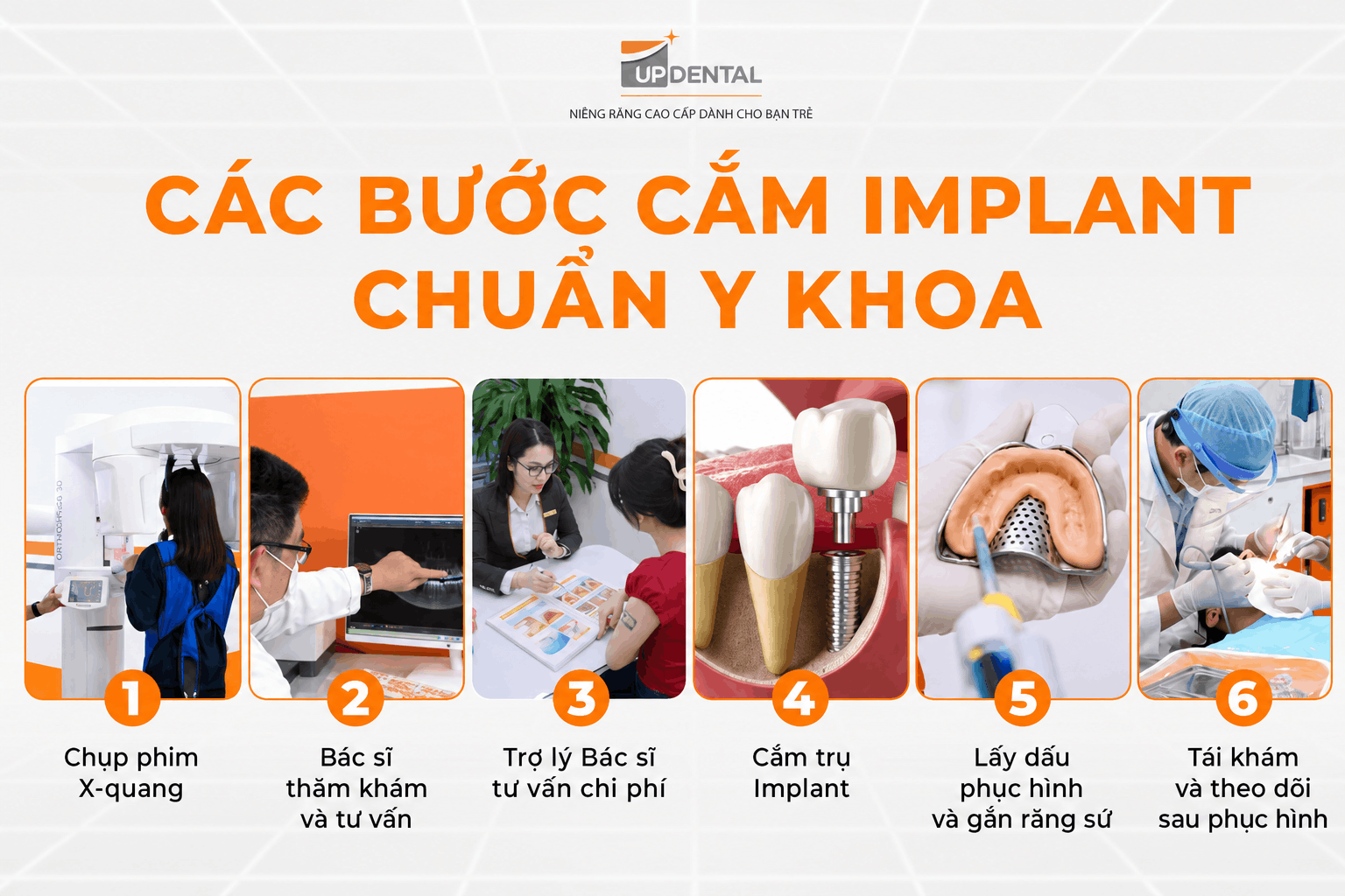 Các bước cắm Implant chuẩn y khoa
