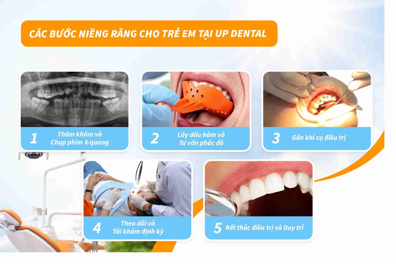 Các bước niềng răng cho trẻ em tại Up Dental