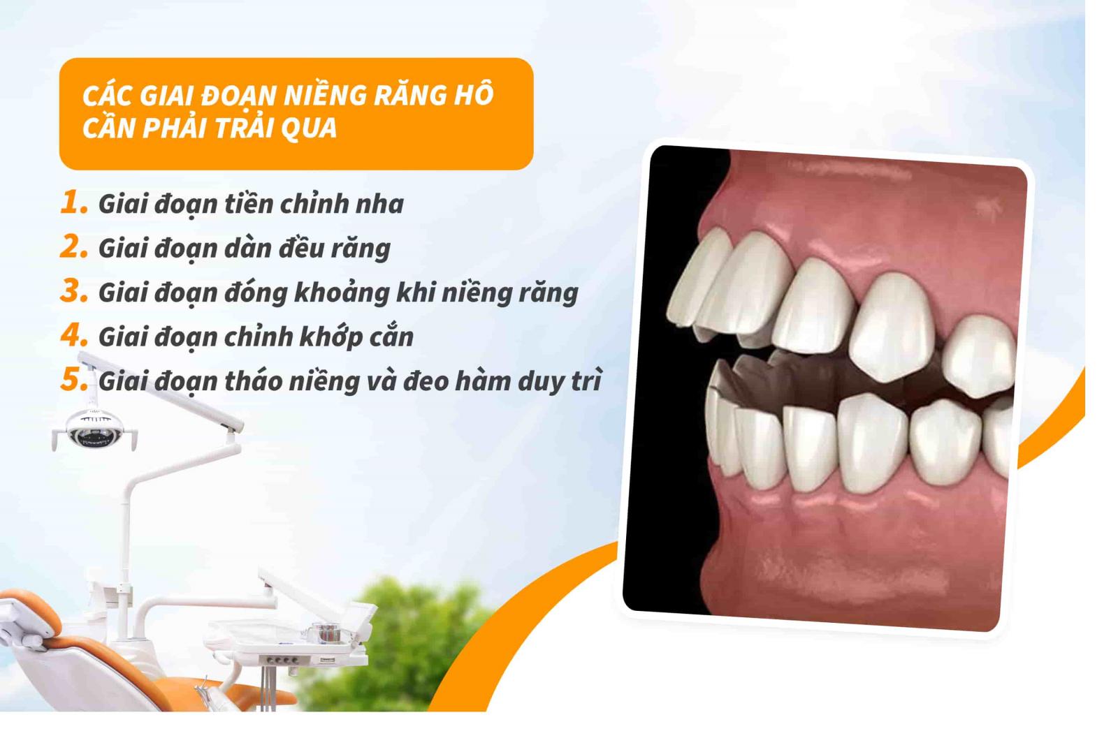 Các giai đoạn niềng răng hô cần phải trải qua