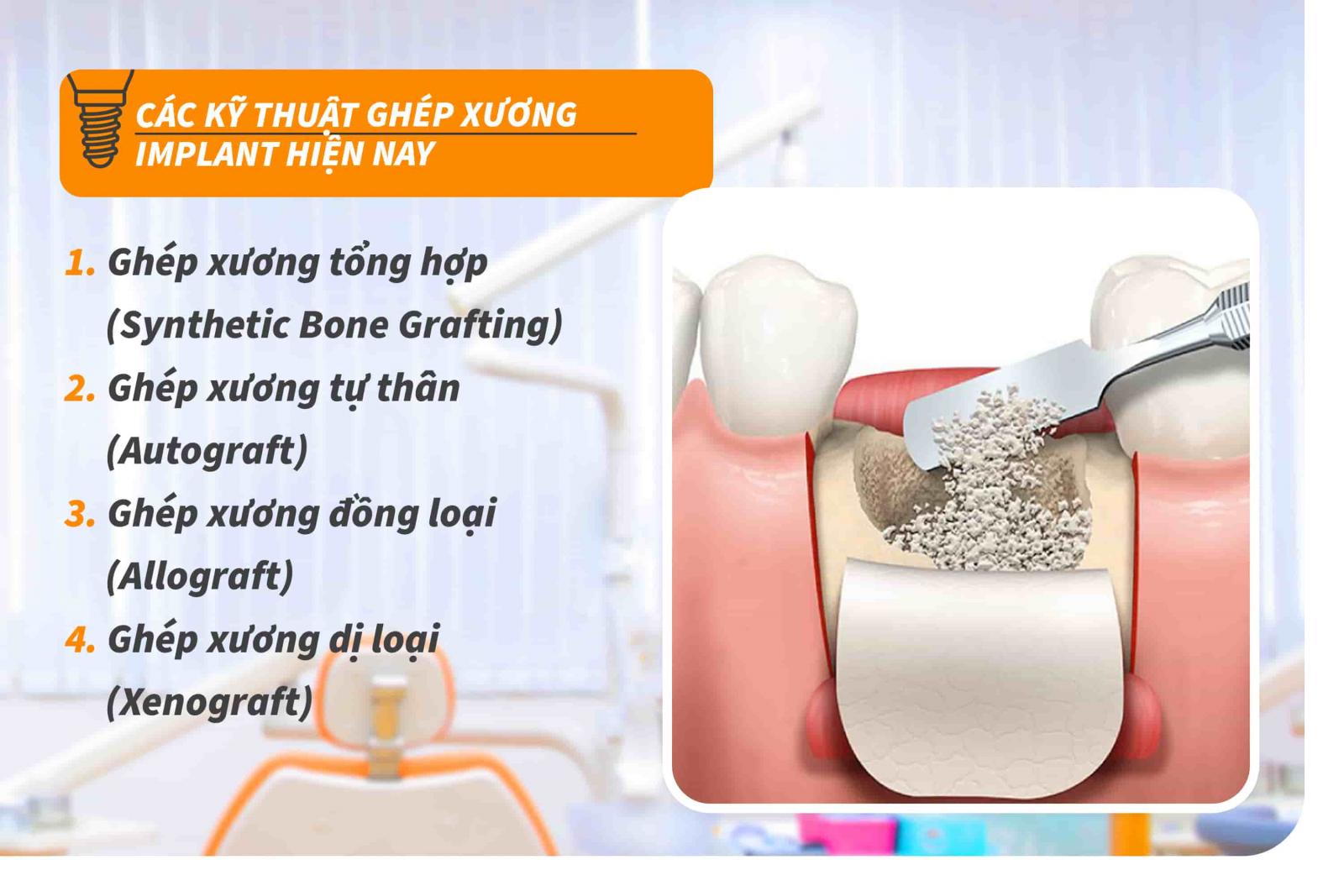 Các kỹ thuật ghép xương Implant hiện nay