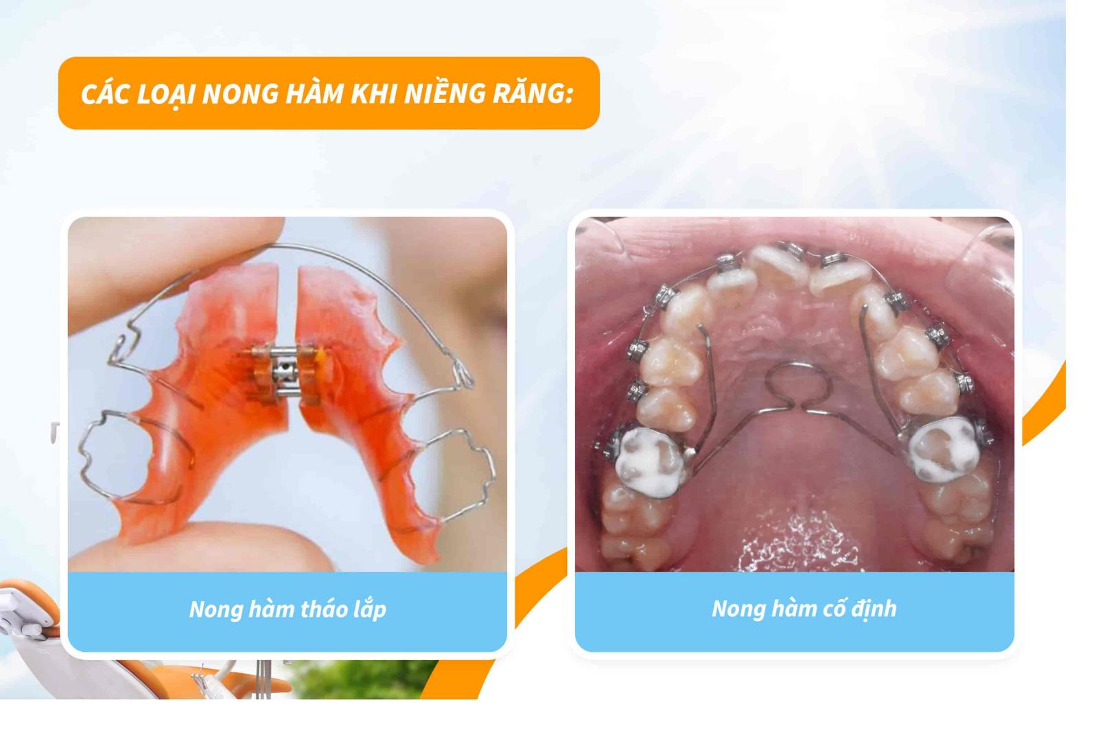 Các loại nong hàm khi niềng răng