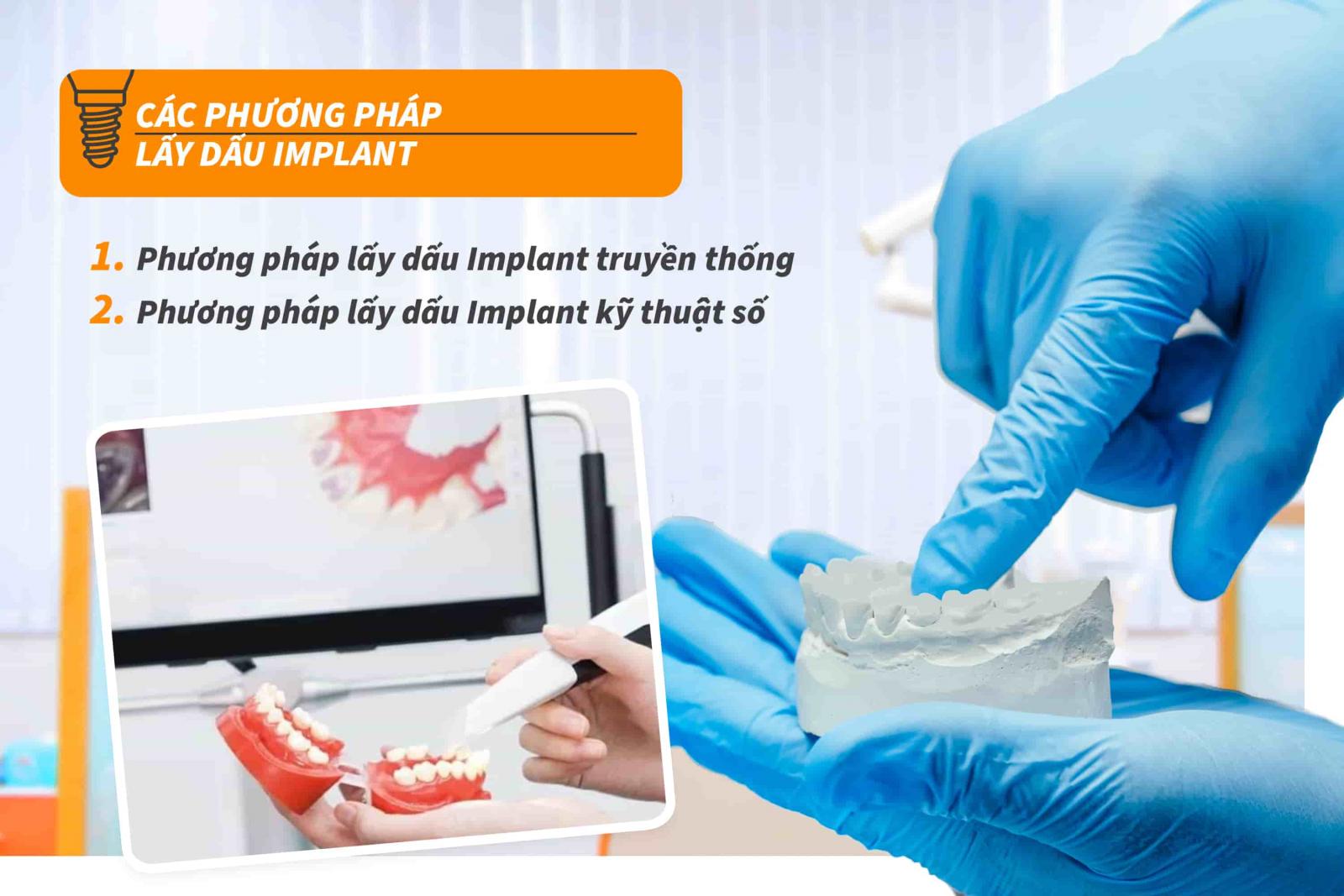 Các phương pháp lấy dấu Implant