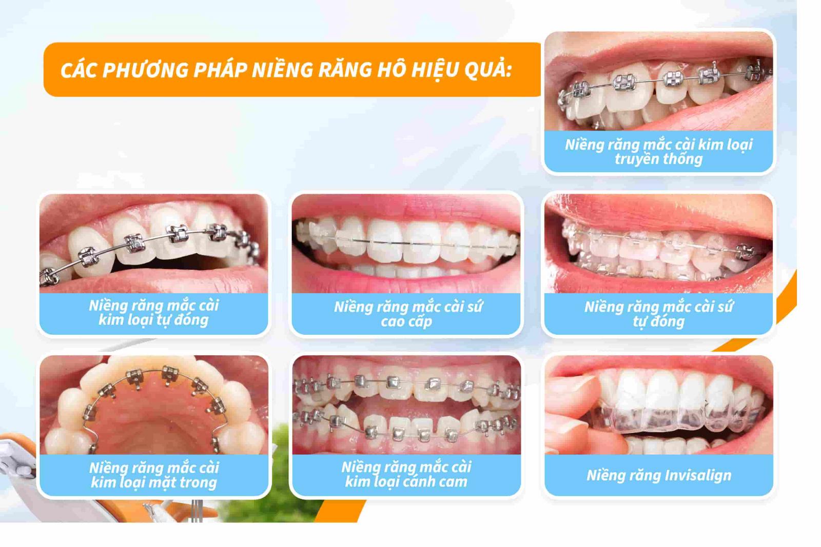 Các phương pháp niềng răng hô hiệu quả