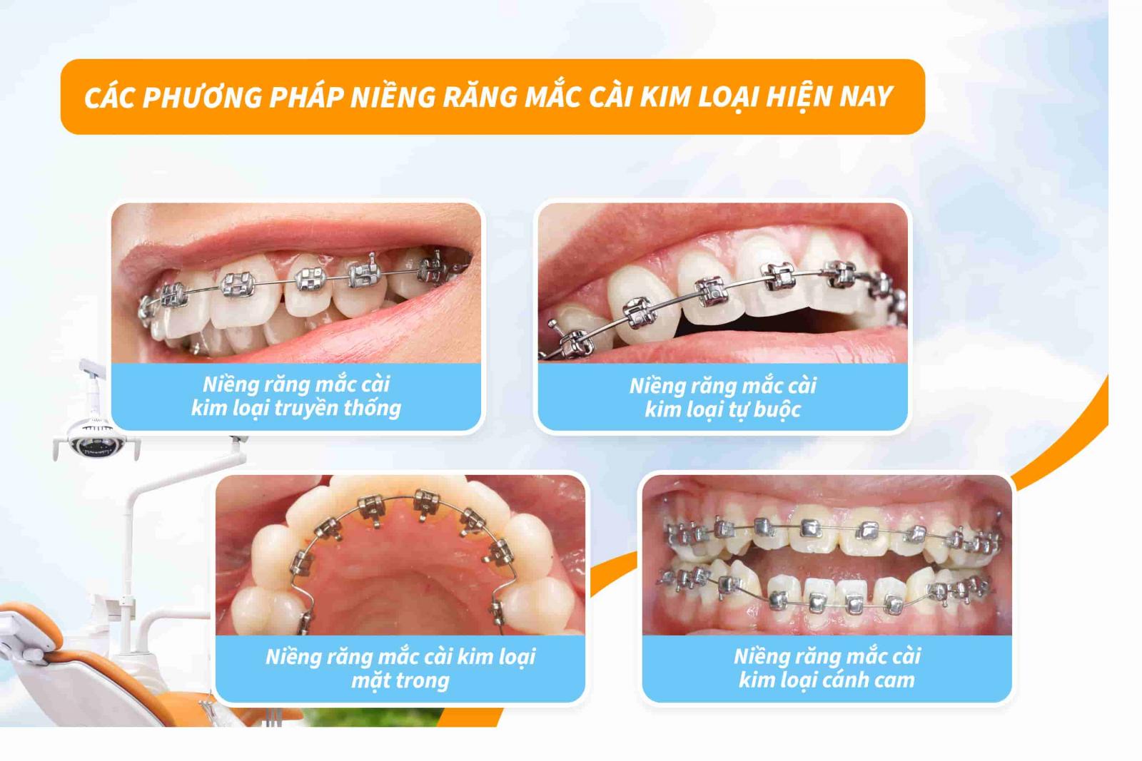 Các phương pháp niềng răng mắc cài kim loại hiện nay