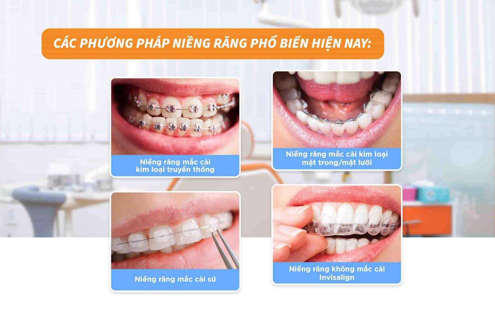 Các phương pháp niềng răng phổ biến hiện nay