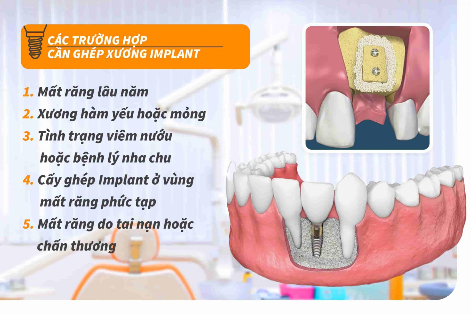 Các trường hợp cần ghép xương Implant