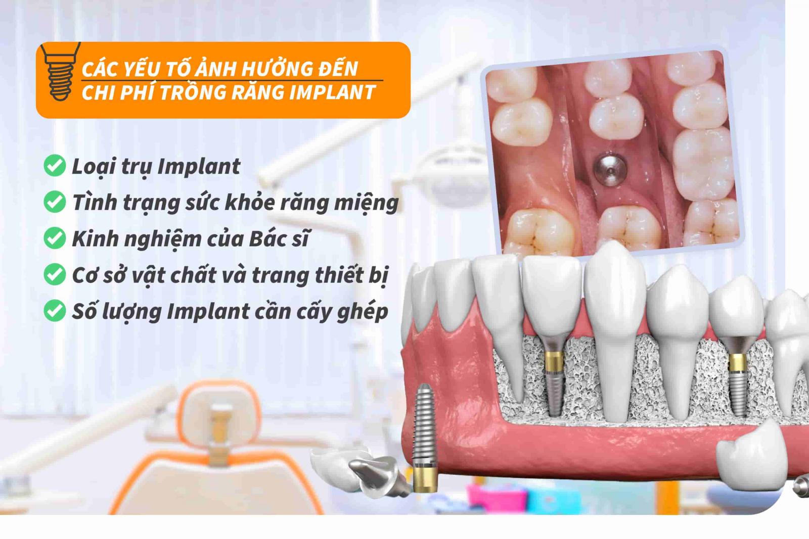 Các yếu tố ảnh hưởng đến chi phí trồng răng Implant