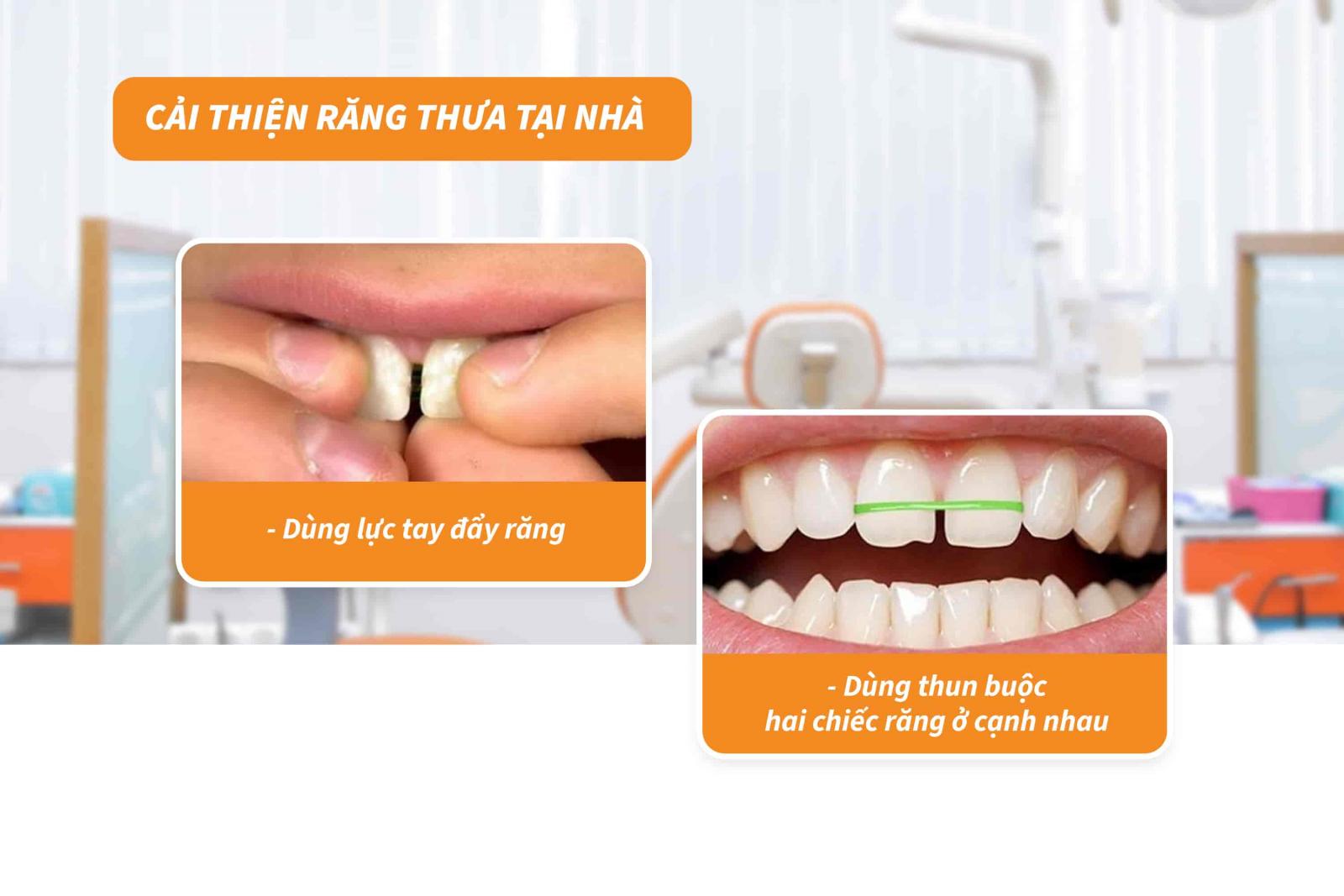 Cải thiện răng thưa tại nhà