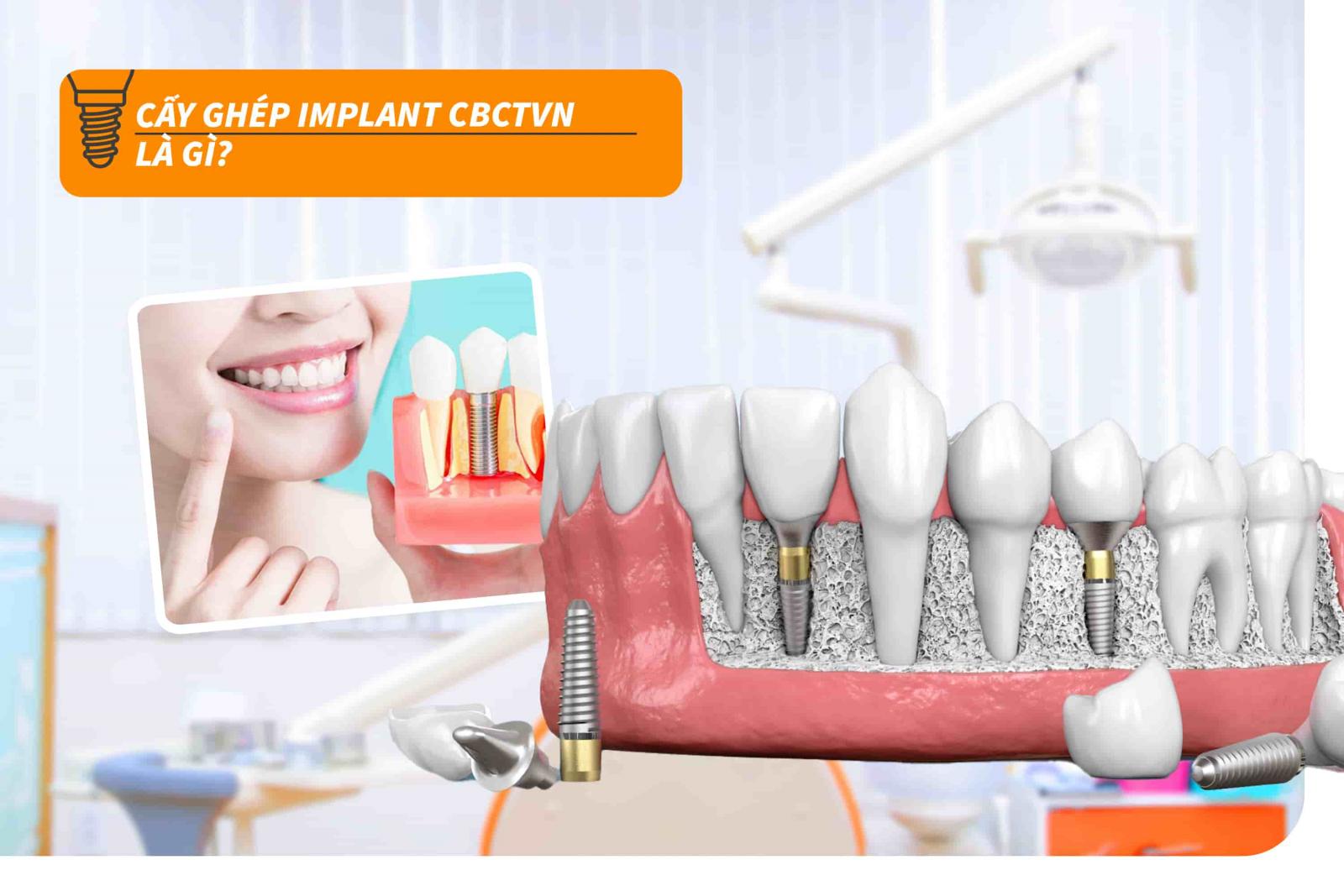 Cấy ghép Implant CBCTVN là gì?