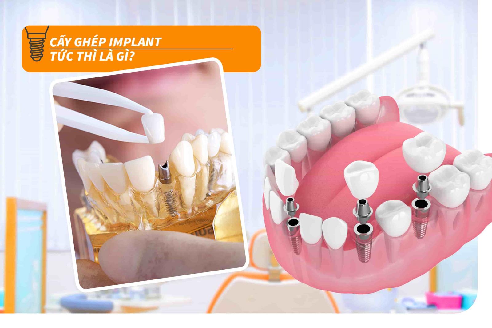 Cấy ghép Implant tức thì là gì?