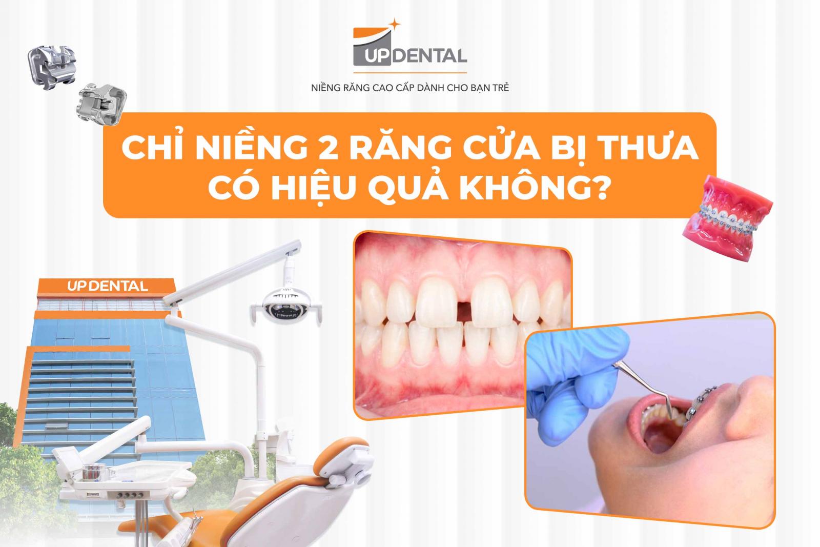 Chỉ niềng 2 răng cửa bị thưa có hiệu quả không?