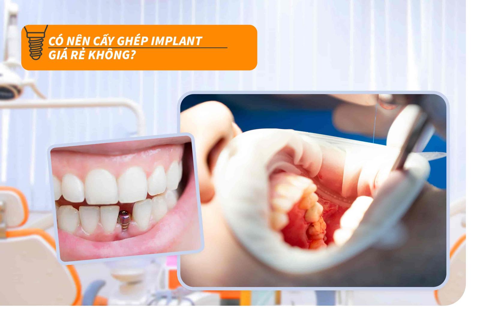 Có nên cấy ghép Implant giá rẻ không?