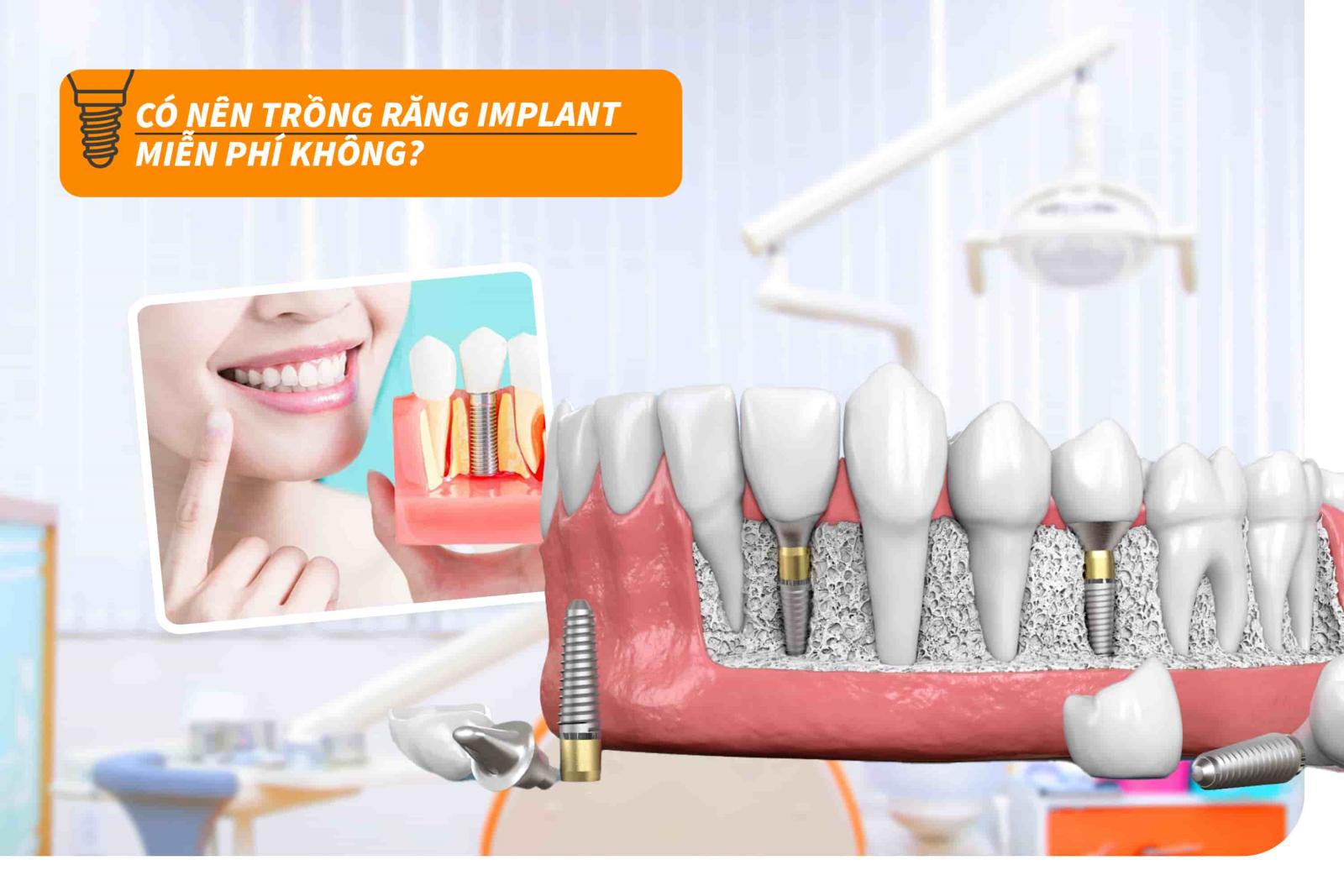 Có nên trồng răng Implant miễn phí không?