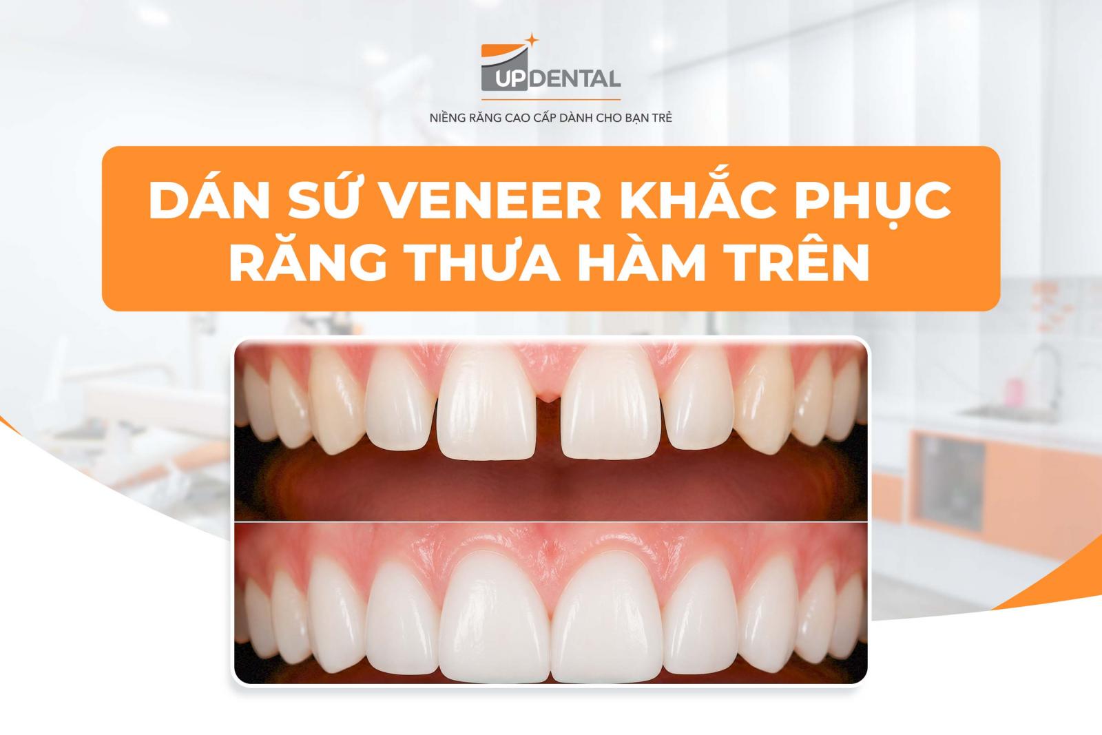 Dán sứ Veneer khắc phục răng thưa hàm trên