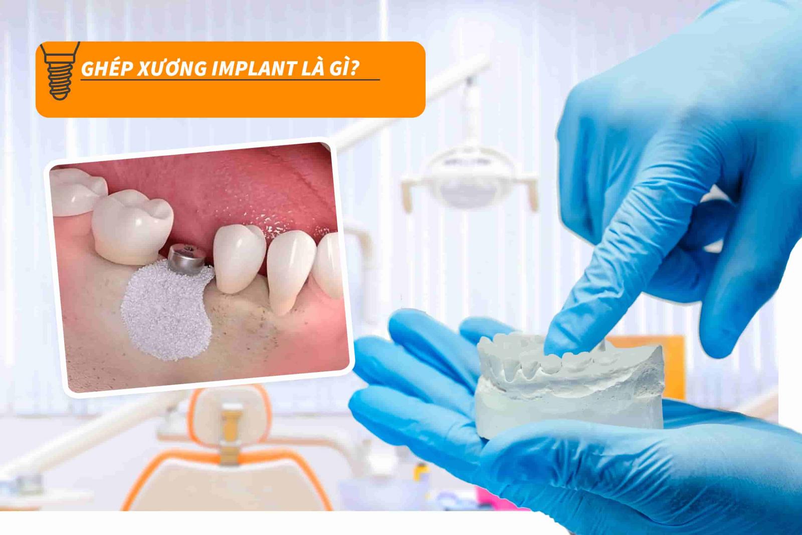 Ghép xương Implant là gì?