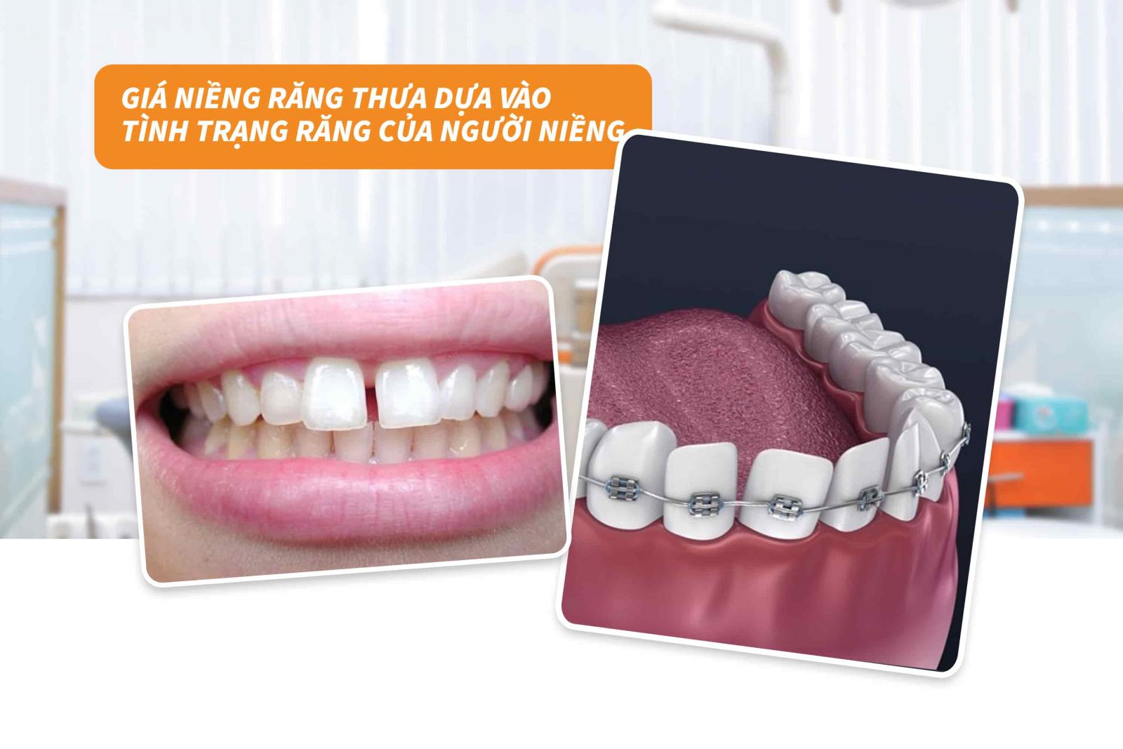 Giá niềng răng dựa vào tình trạng răng của người niềng