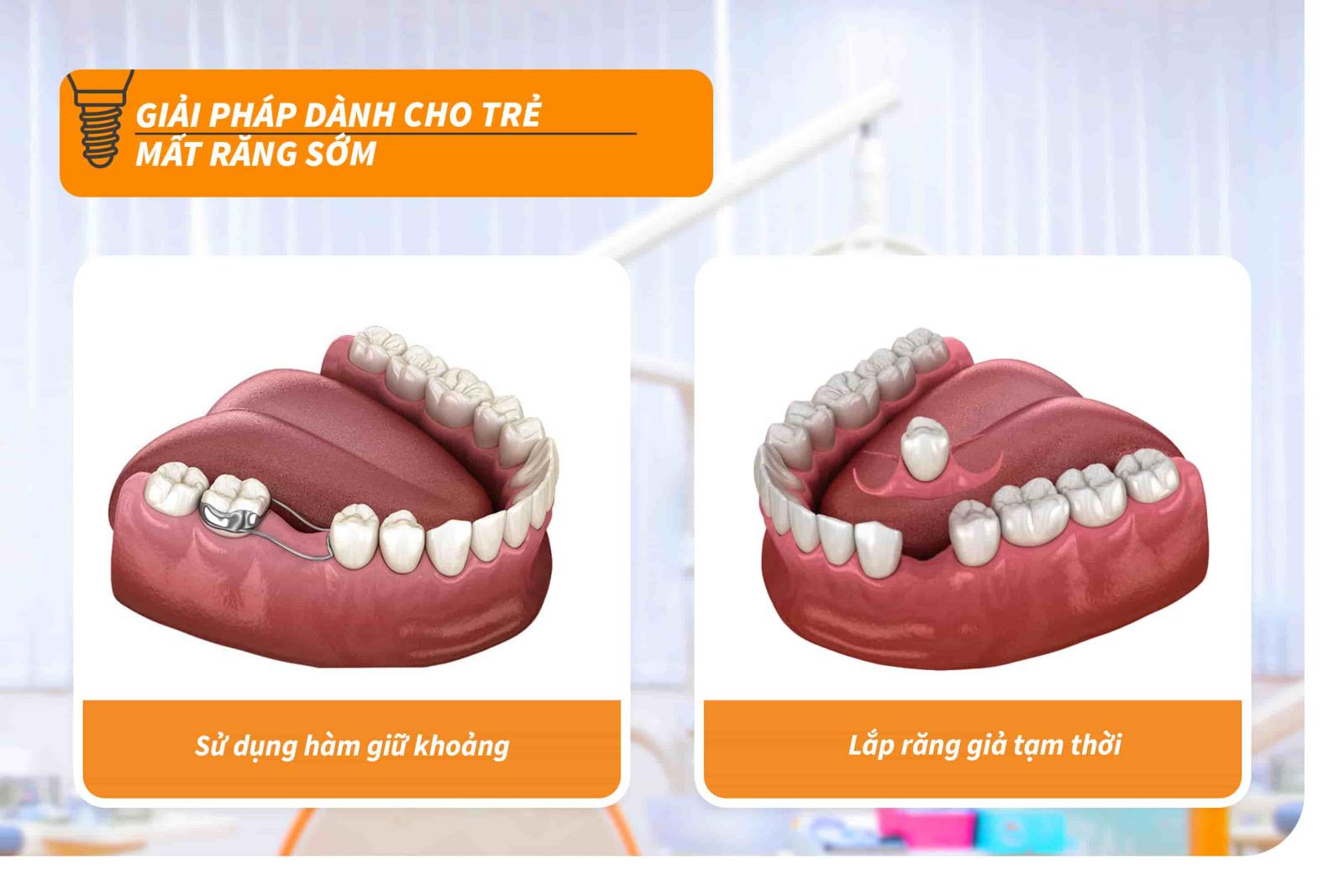 Giải pháp dành cho trẻ mất răng sớm