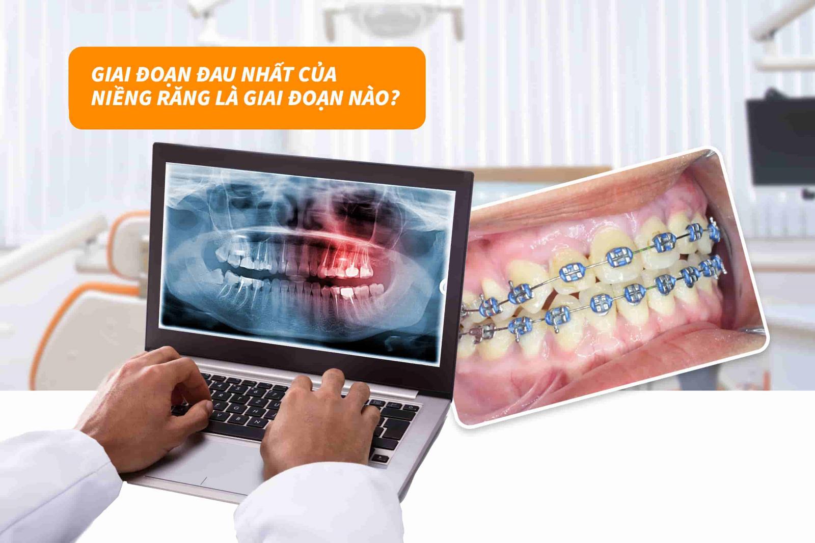 Giai đoạn đau nhất của niềng răng là giai đoạn nào?
