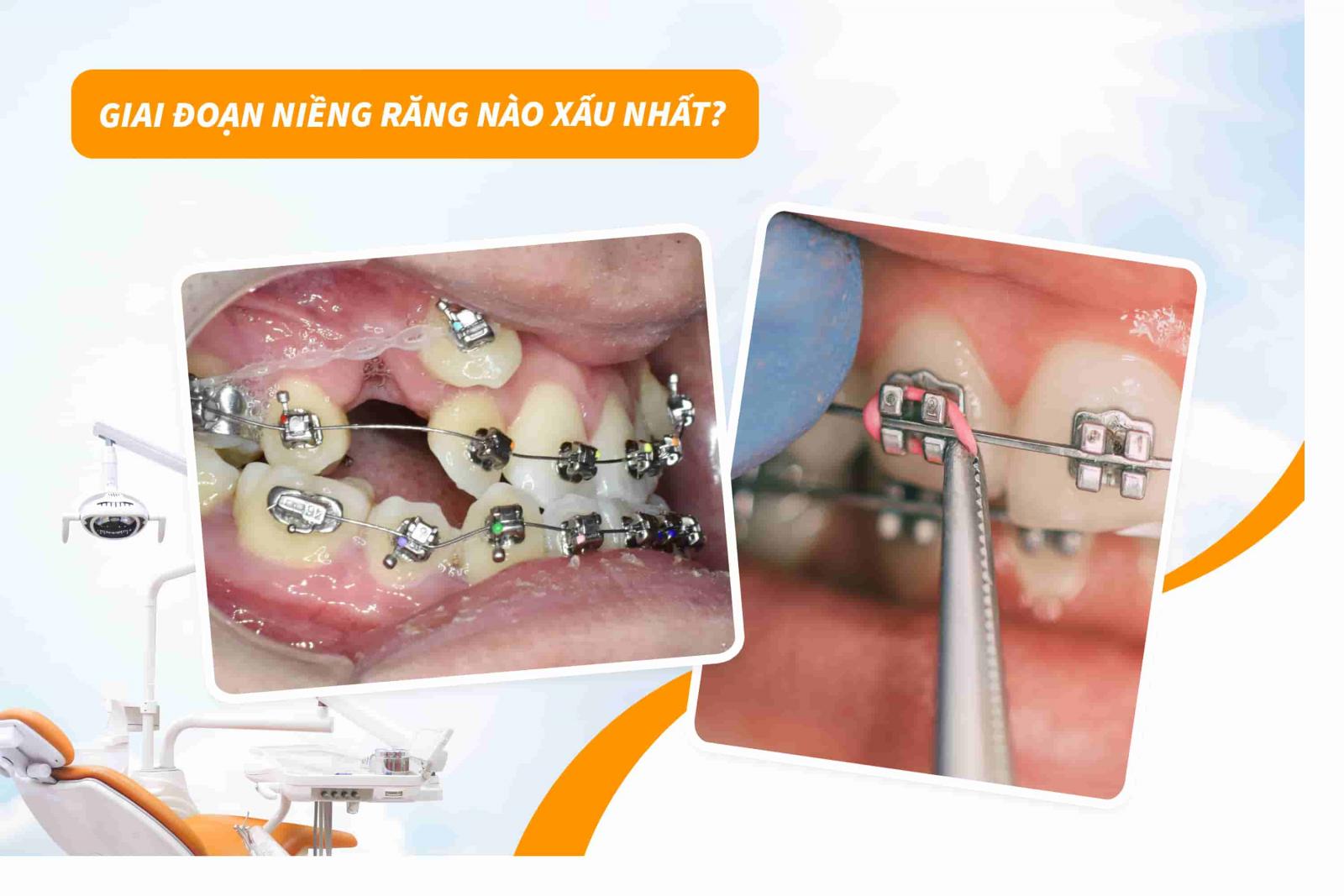 Giai đoạn niềng răng nào xấu nhất?