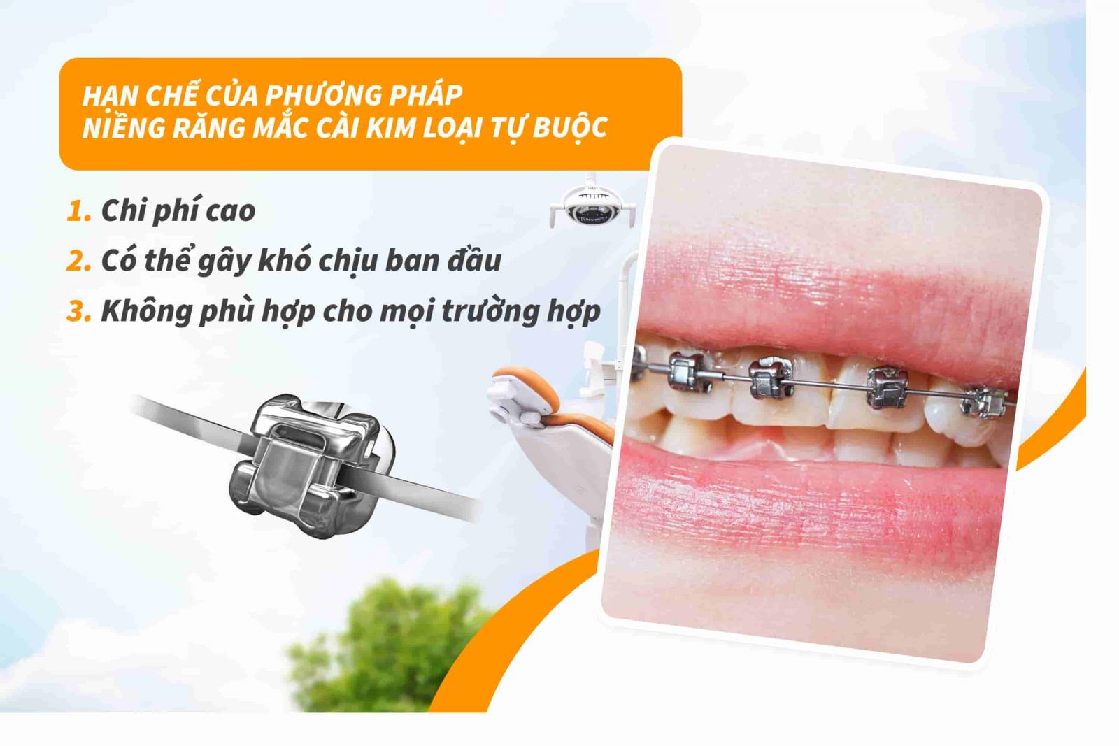Hạn chế của phương pháp niềng răng mắc cài kim loại tự buộc