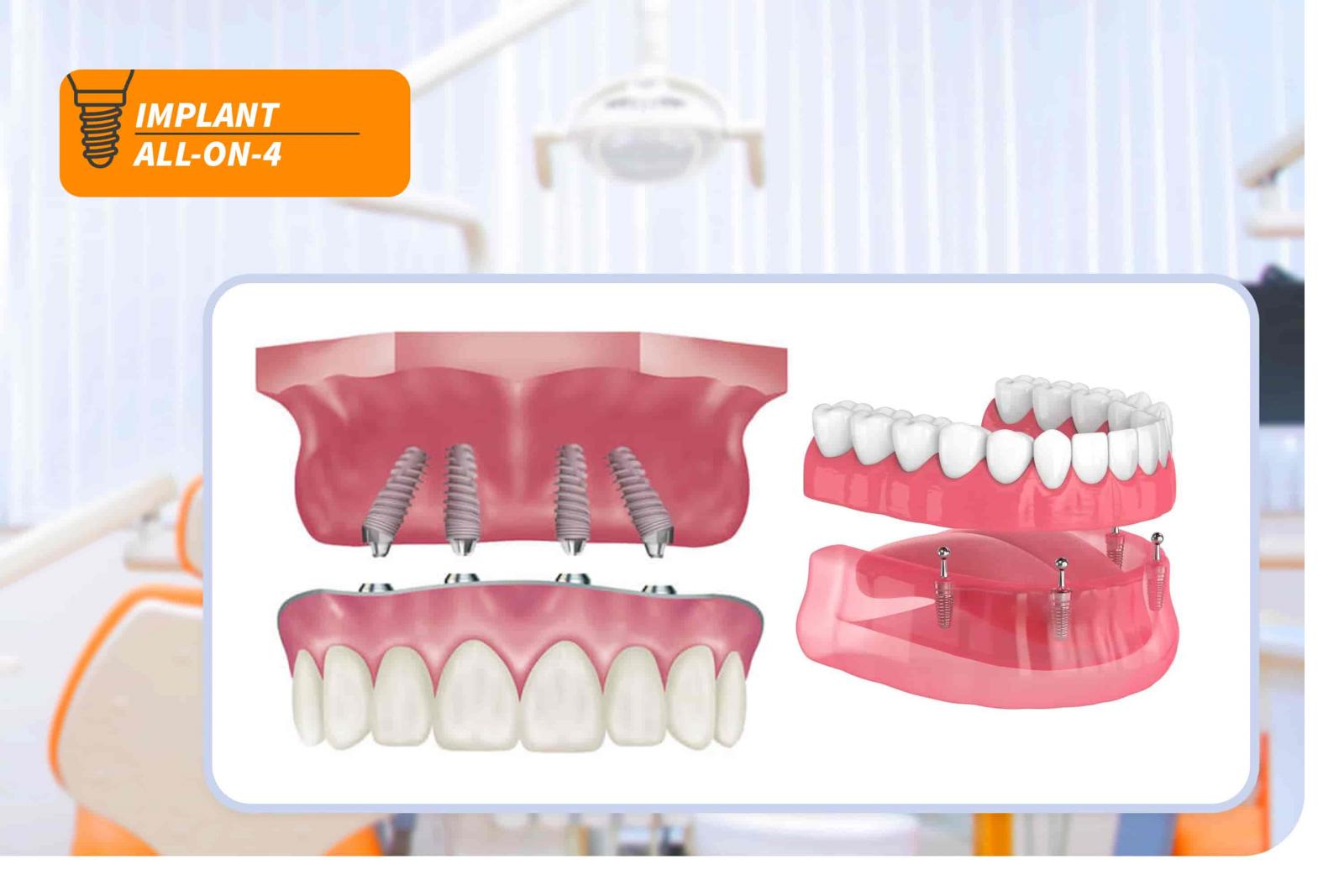 Implant All-on-4