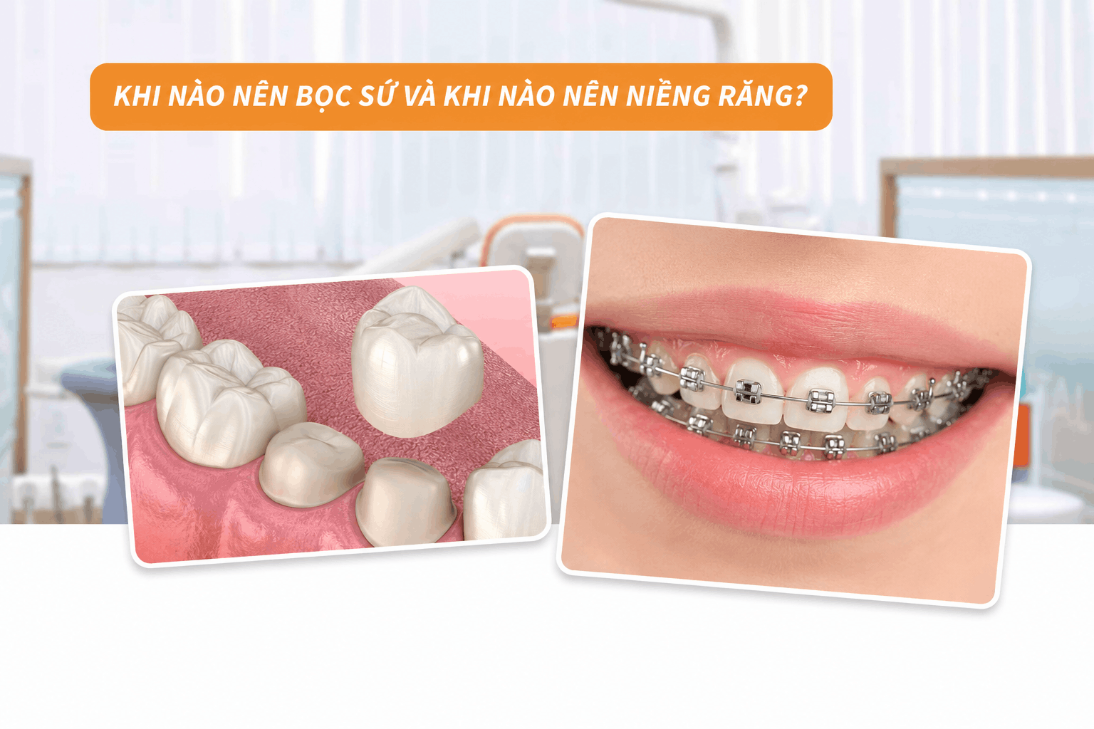 Khi nào nên bọc sứ và khi nào nên niềng răng?