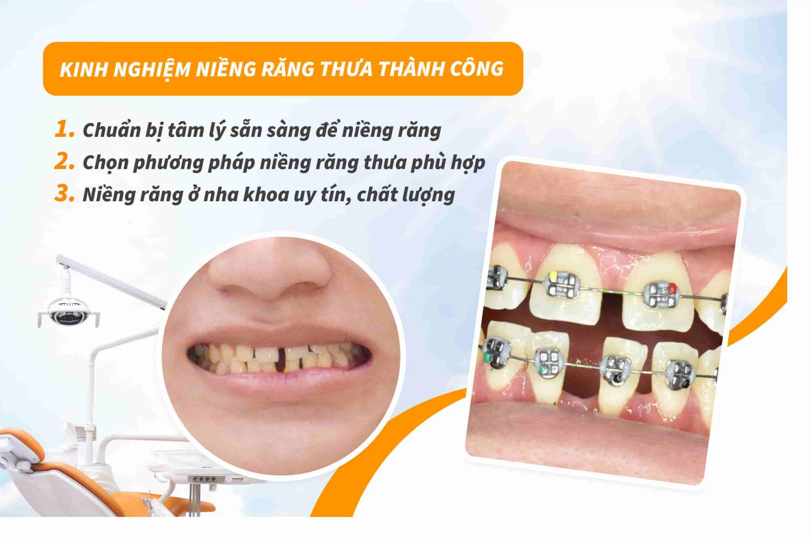 Kinh nghiệm niềng răng thưa thành công