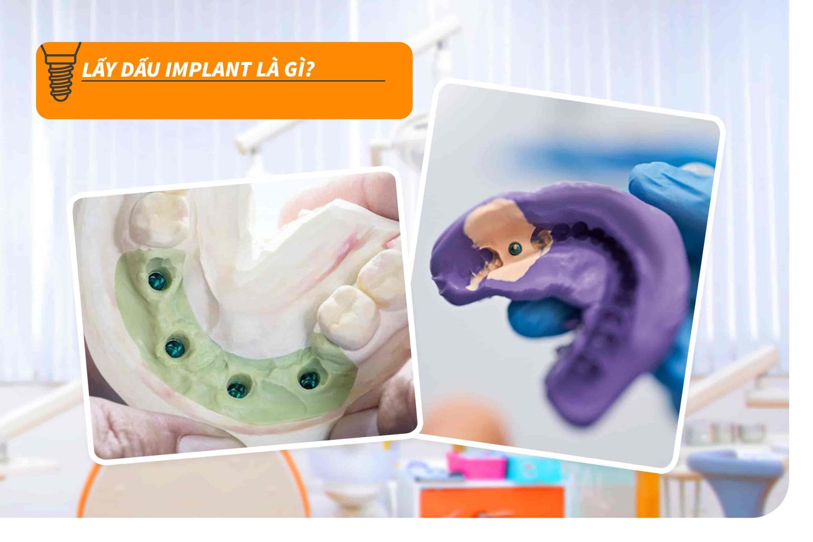 Lấy dấu Implant là gì?