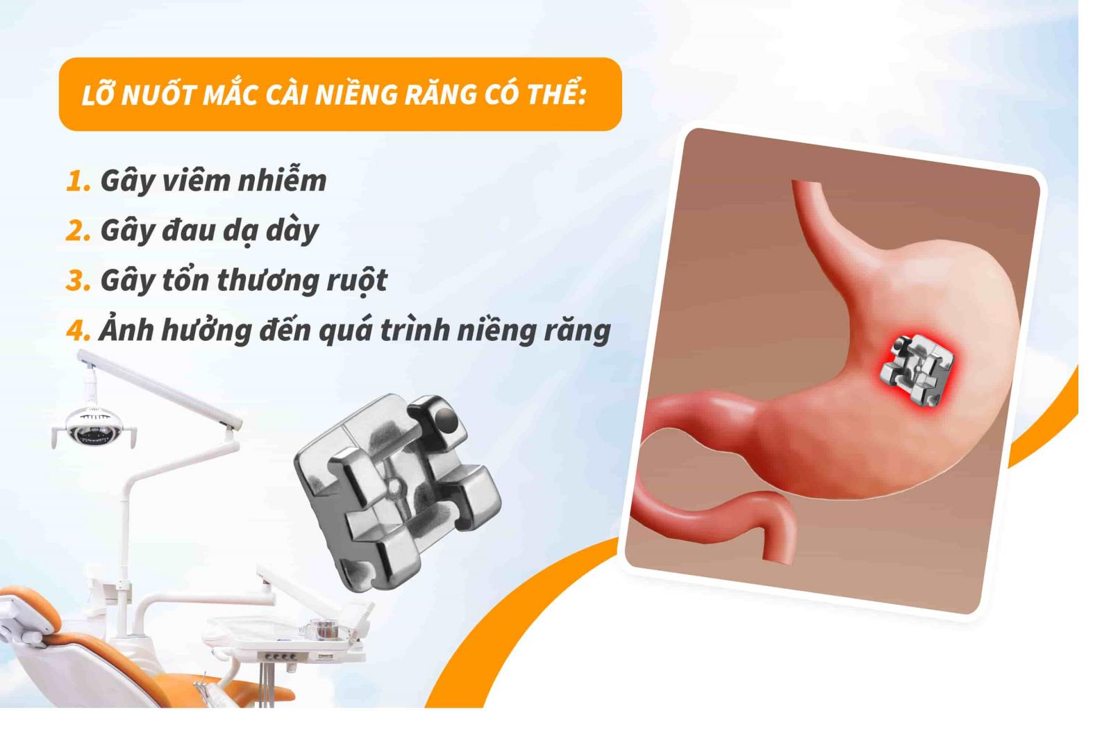 Lỡ nuốt mắc cài niềng răng có nguy hiểm không