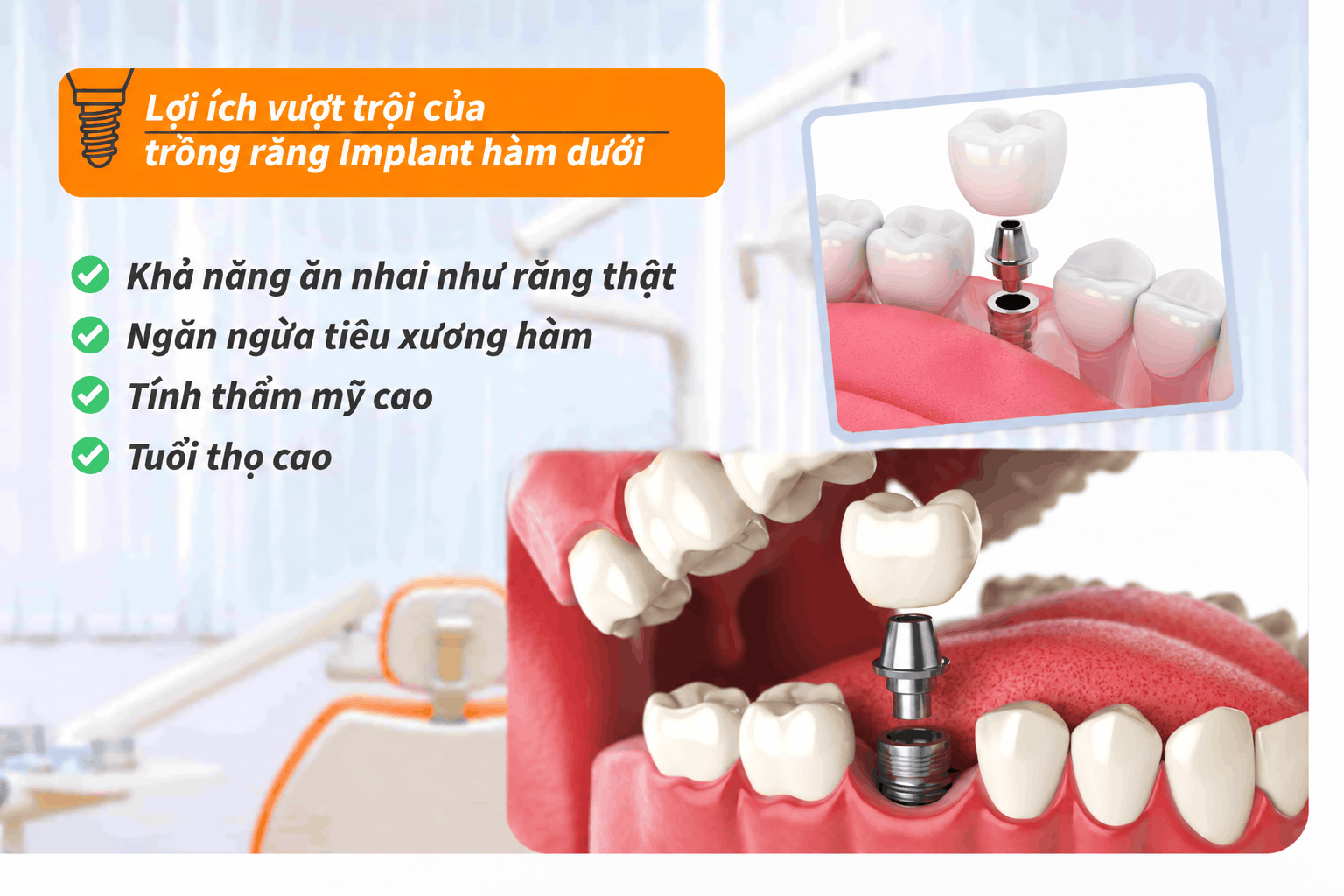 Lợi ích vượt trội của trồng răng Implant hàm dưới