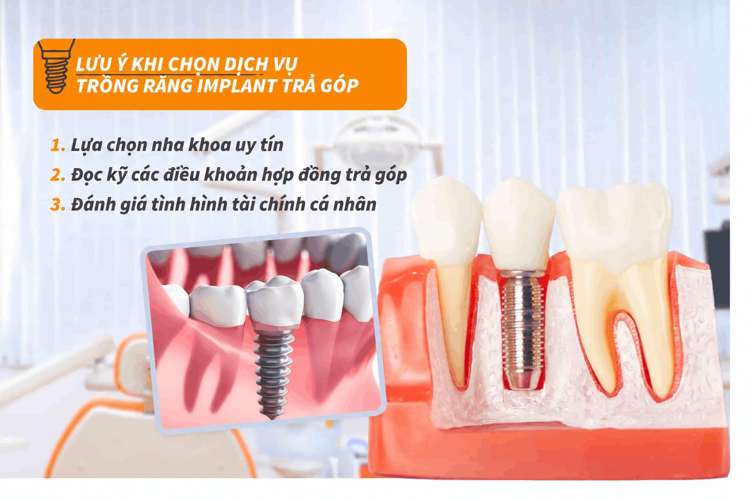 Lưu ý khi chọn dịch vụ trồng răng Implant trả góp