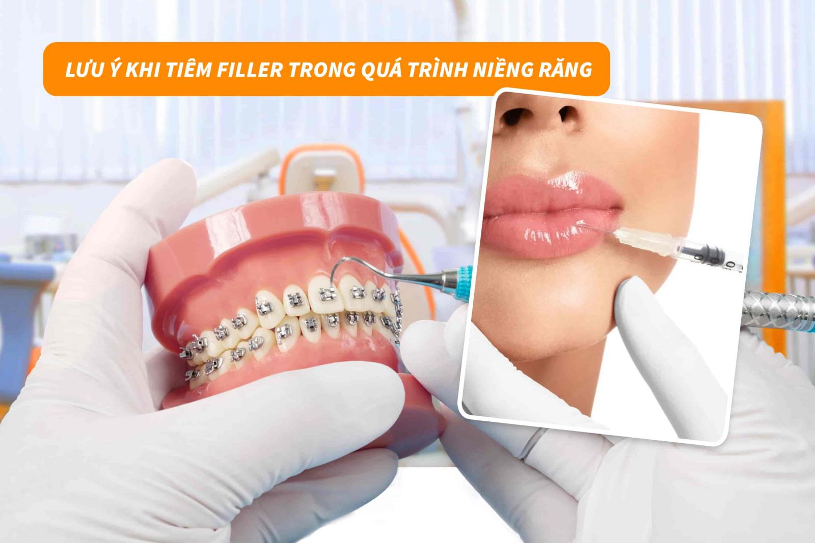 Lưu ý khi tiêm filler trong quá trình niềng răng