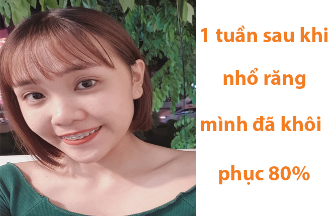 nhổ răng