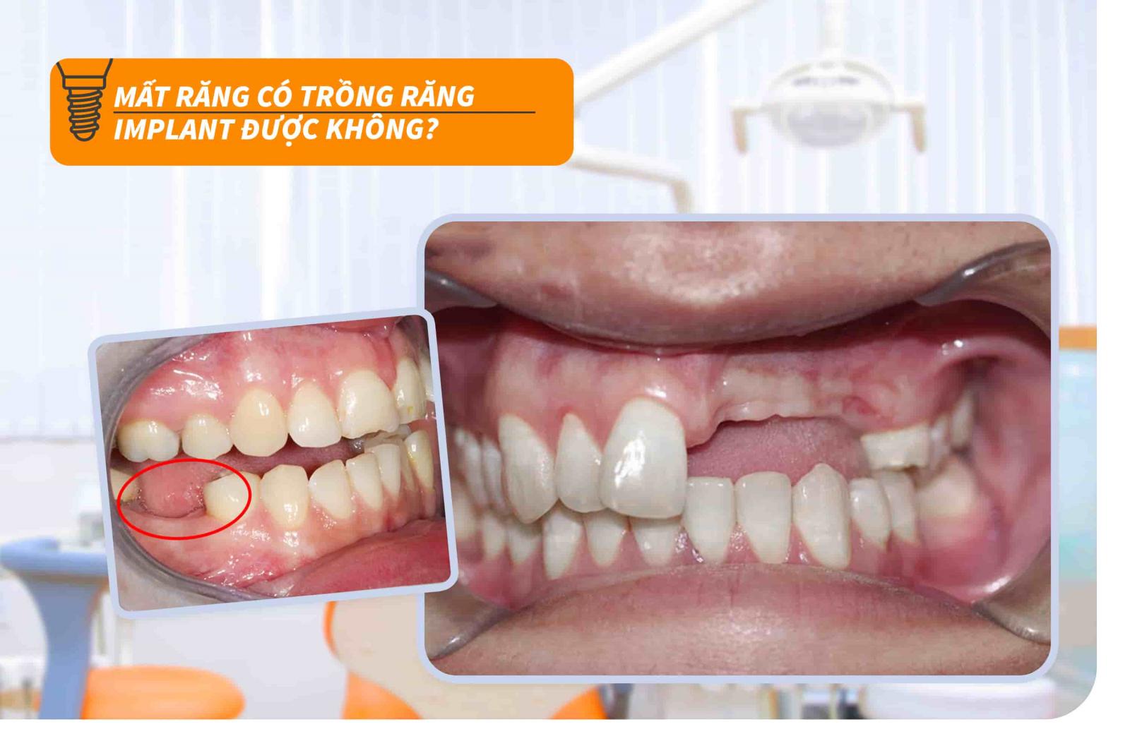 Mất răng thì có trồng răng Implant được không?