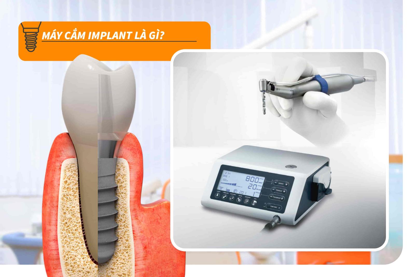 Máy cắm Implant là gì