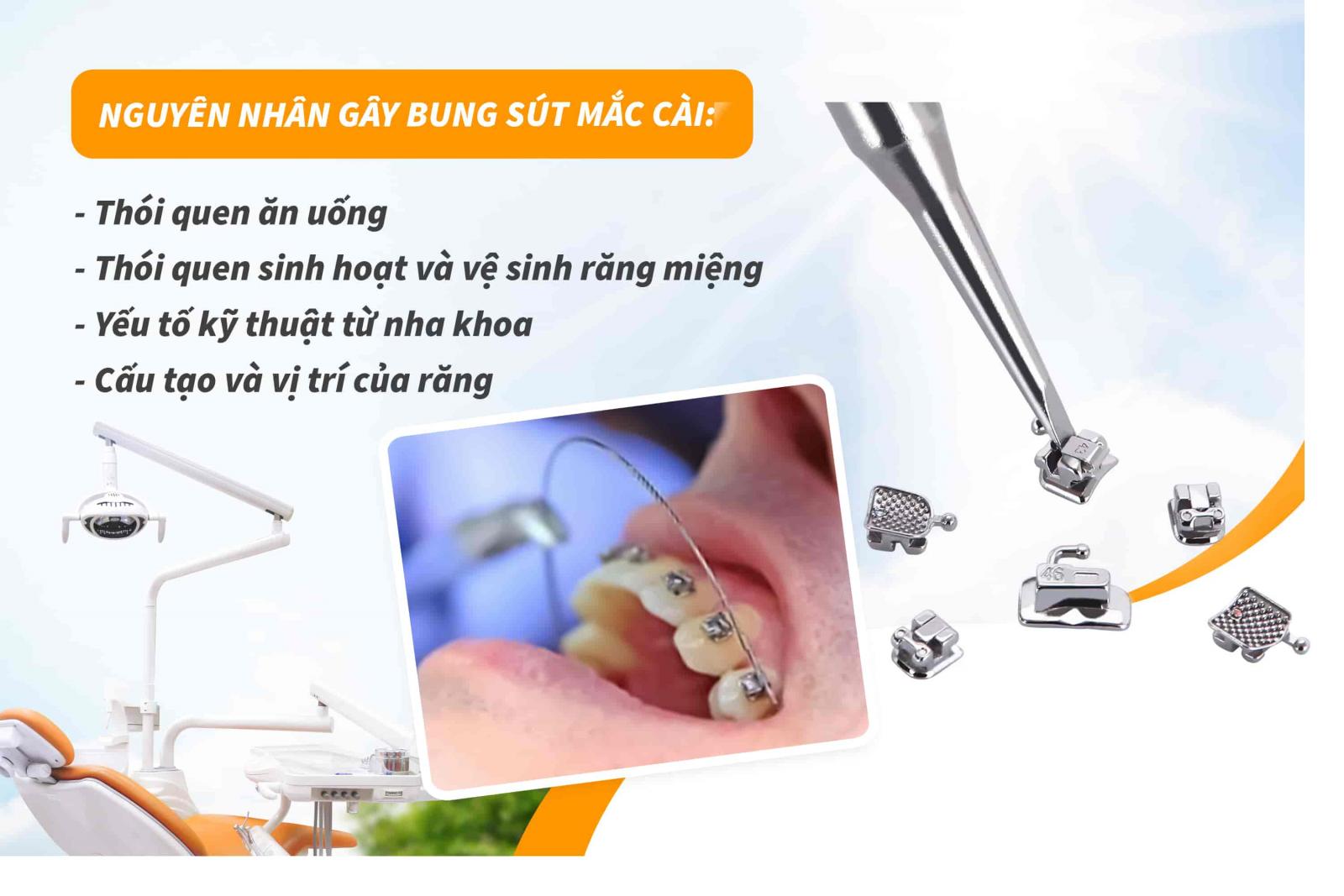 Nguyên nhân gây bung sút mắc cài
