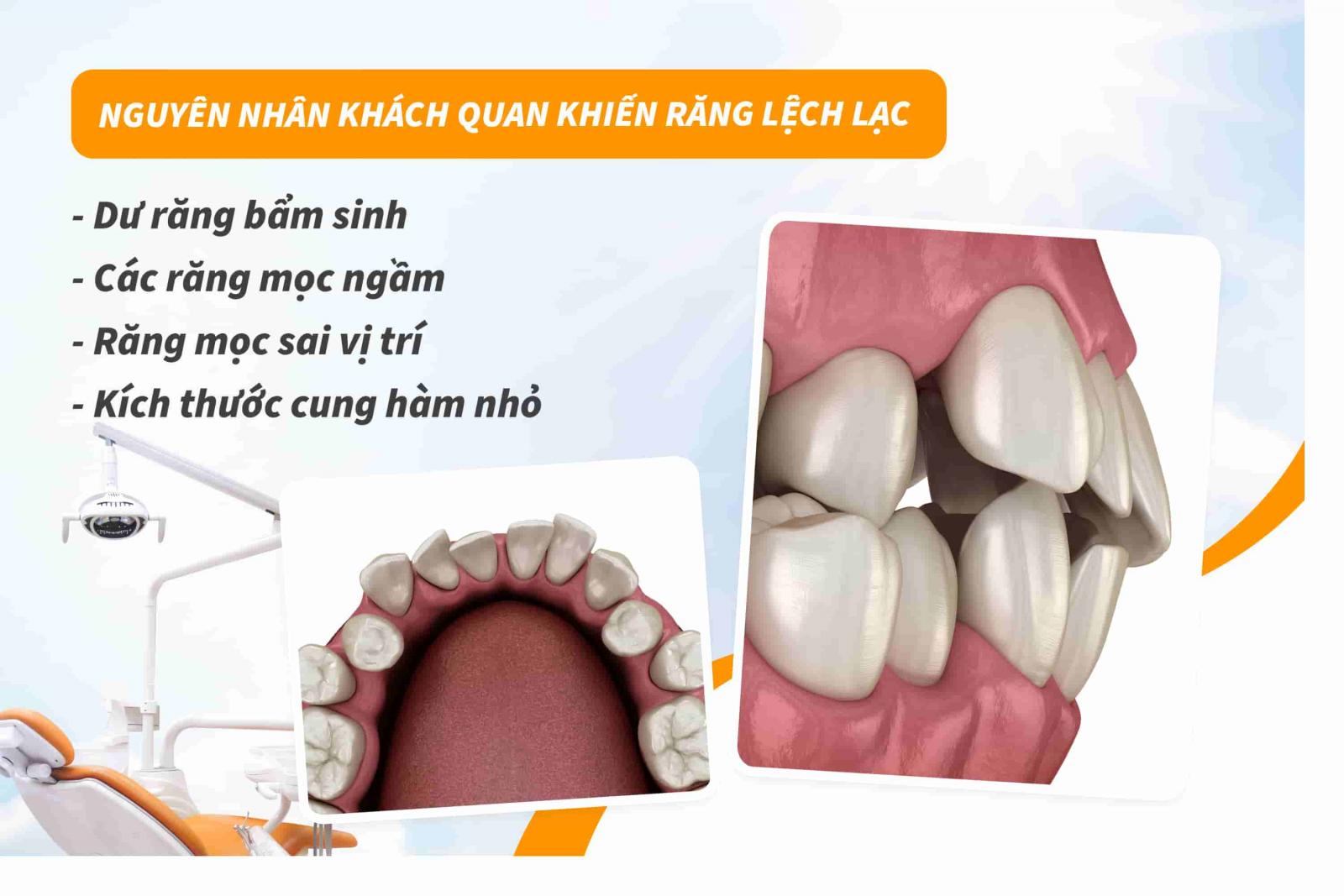 Nguyên nhân khách quan khiến răng lệch lạc