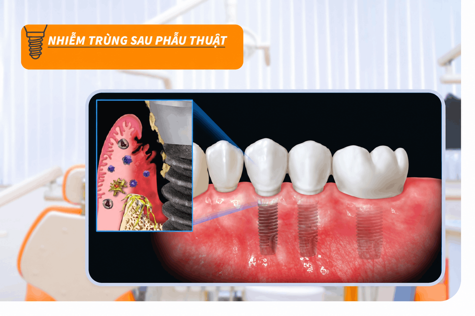 Nhiễm trùng sau phẫu thuật