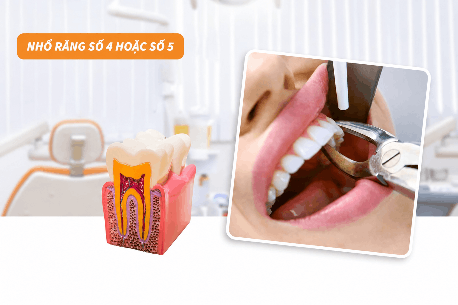 Nhổ răng số 4 hoặc số 5
