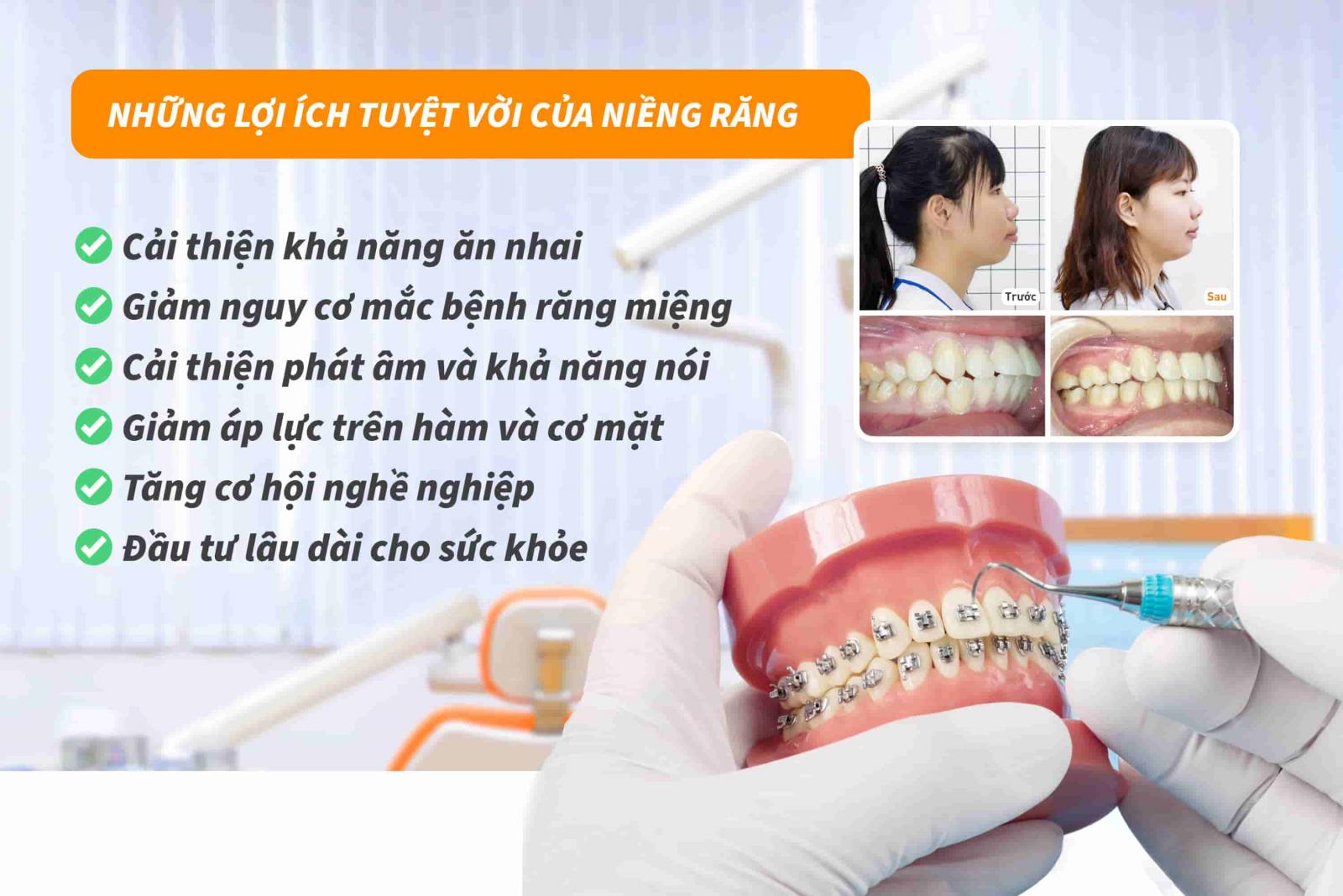 Những lợi ích tuyệt vời của niềng răng