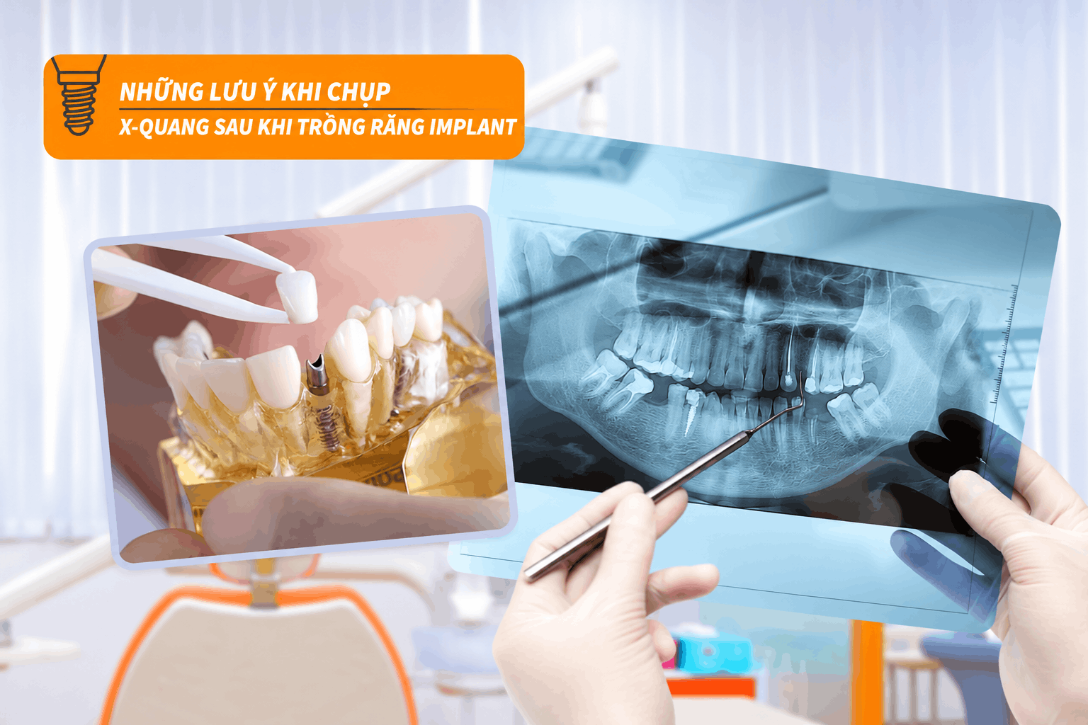 Những lưu ý khi chụp X-quang sau khi trồng răng Implant