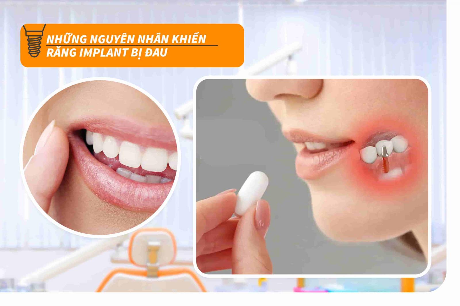 Những nguyên nhân khiến răng Implant bị đau