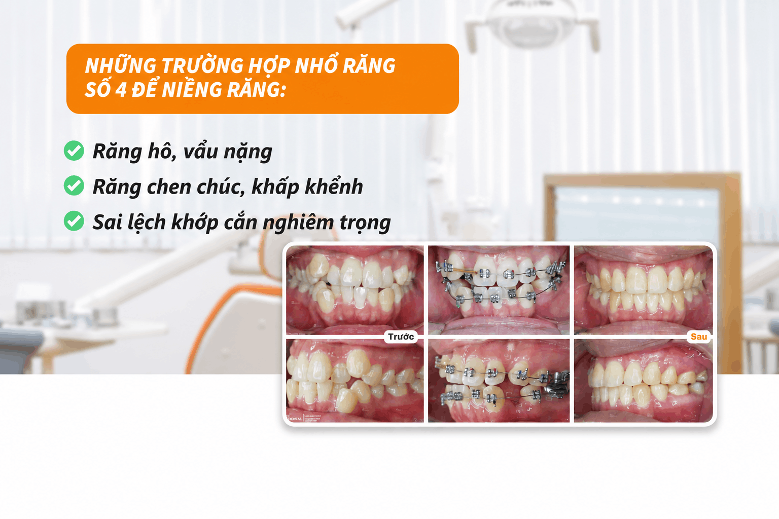 Những trường hợp cần nhổ răng số 4 để niềng răng